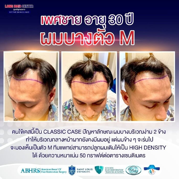 คลินิกปลูกผม, ปลูกผมที่ไหนดี