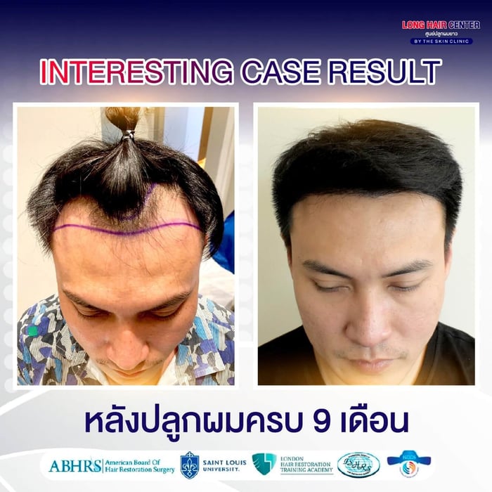 คลินิกปลูกผม, ปลูกผม FUE