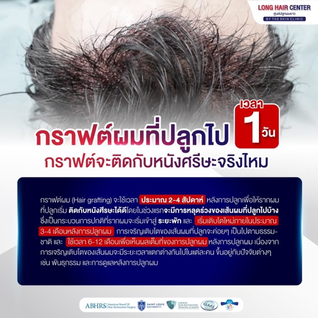 กราฟต์ผมที่ปลูกไปภาย ใน 1 วัน กราฟต์จะติดกับหนังศีรษะจริงไหม?