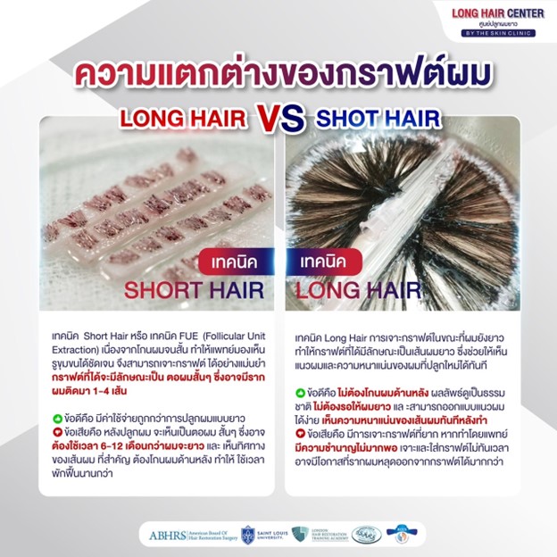 ลักษณะเส้นผมที่ต่างกัน ใช้กราฟต์ต่างกันไหม?