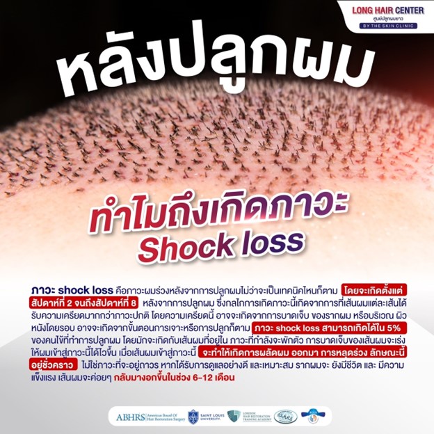 ทำไมถึงเกิดภาวะ Shock Loss หลังปลูกผม?