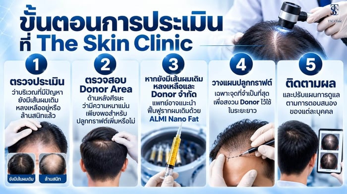 แพทย์ประเมินผมบางแต่ยังไม่ล้าน วางแผนฟื้นฟูรากผมเดิมหรือปลูกผมที่ The Skin Clinic