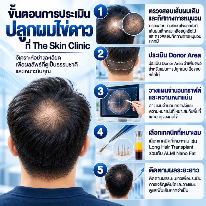 ขั้นตอนการประเมินทิศทางเส้นผมไข่ดาวและวางแผนปลูกผมระยะยาวที่ The Skin Clinic