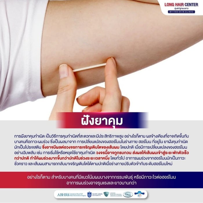 ภาวะผมร่วง เป็นผลมาจากการเปลี่ยนแปลงของฮอร์โมนในร่างกาย ฮอร์โมนที่อยู่ในยาฝังคุมกำเนิดมักเป็นโปรเจสติน (Progestin) ซึ่งอาจมีผลต่อวงจรการเจริญเติบโตของเส้นผม