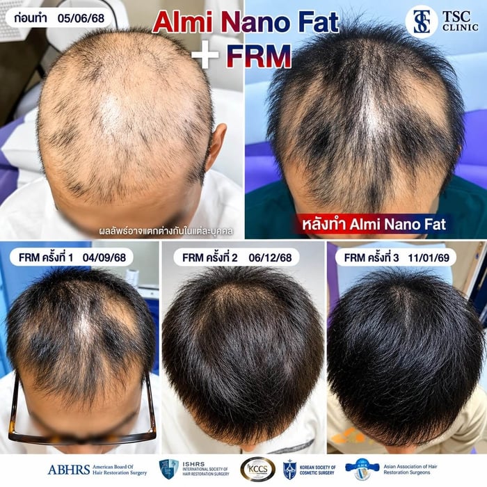 ผลลัพธ์เคสจริง วัยรุ่นผมร่วงทั่วศีรษะ หลังรักษาด้วย ALMI Nano Fat และ FRM