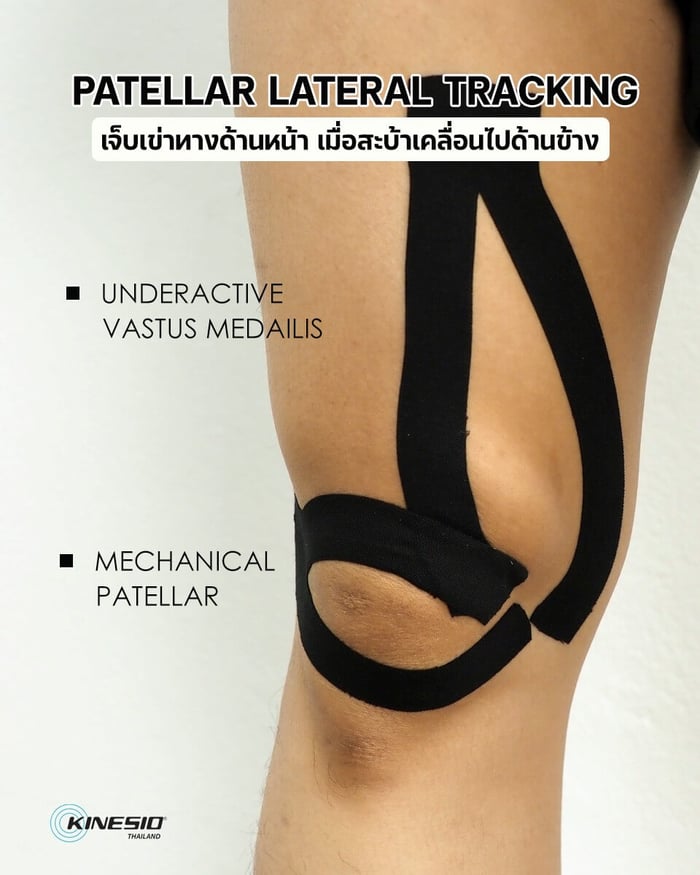 เจ็บเข่าทางด้านหน้า เมื่อสะบ้าเคลื่อนไปด้านข้าง (Patellar Lateral Tracking)