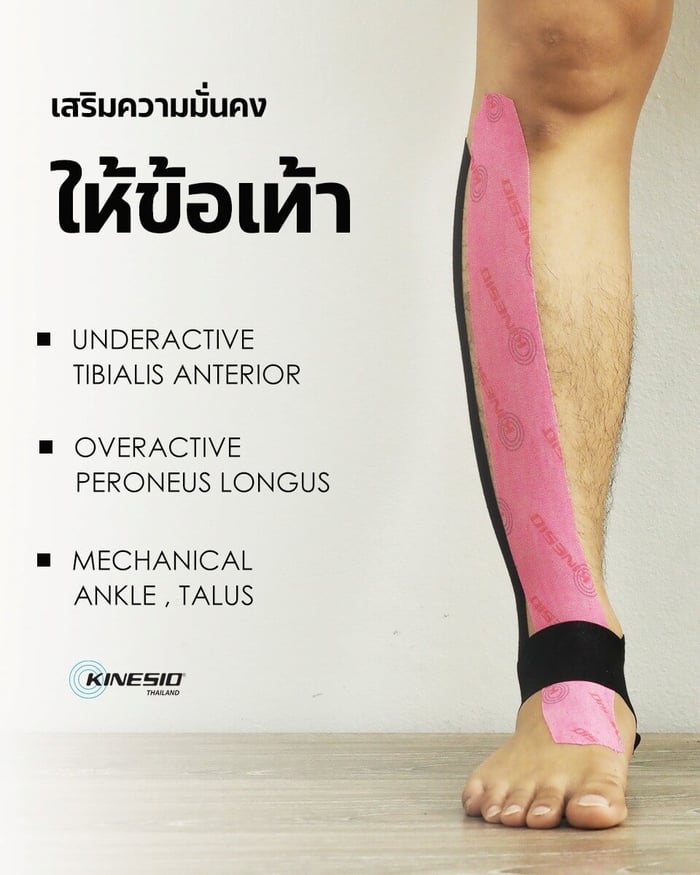 เสริมความมั่นคงให้ข้อเท้า (Ankle Stability) ด้วยคิเนซิโอเทป