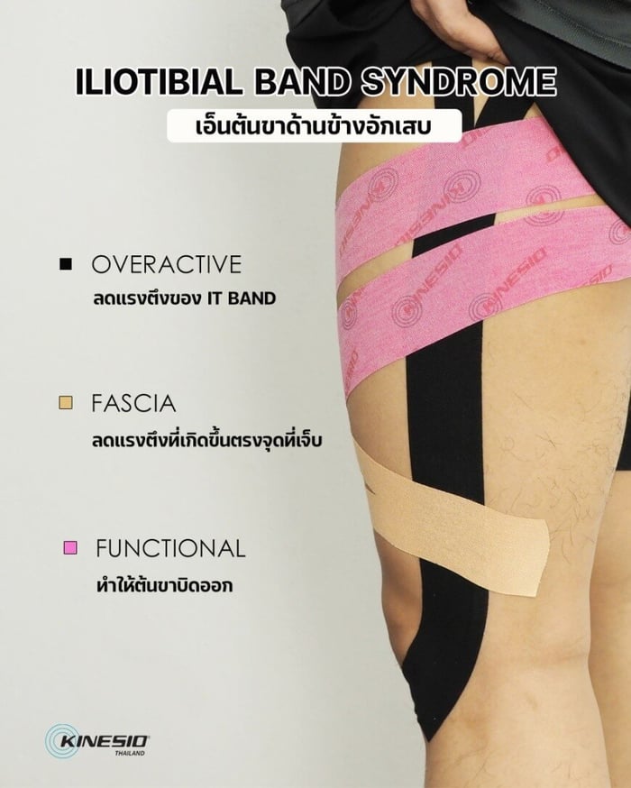 เอ็นต้นขาด้านข้างอักเสบ (Iliotibial Band Syndrome)