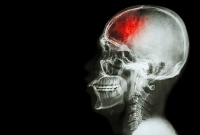 โดยทั่วไปการรักษาทางกายภาพบำบัดจะเริ่มทันทีที่อาการของผู้ป่วยเริ่มคงที่ ในช่วงแรกของอาการผู้ป่วยจะมีการอ่อนแรง (Flaccid) และต่อมาจะเกิดอาการเกร็งตัวของกล้ามเนื้อที่เรียกว่าภาวะ Spasticity ตามขึ้นมาและร่วมกับอาการผิดปกติอื่น ๆ