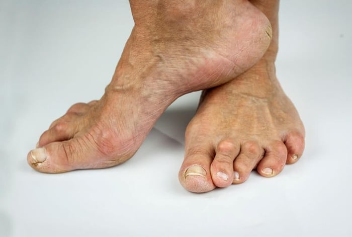 เป็นโรคที่ระบบภูมิคุ้มกันทำร้ายข้อของตนเอง ทำให้เข่าบวม แดง และปวดตลอดเวลา