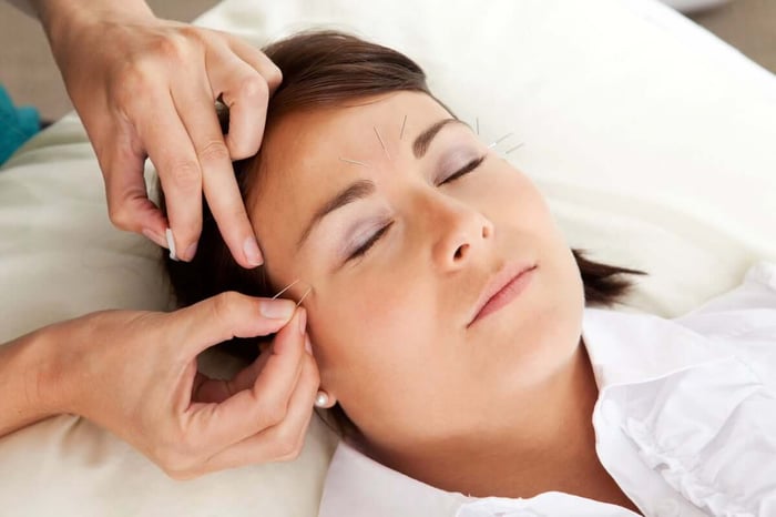 Facial Acupuncture for Dark Circles and Puffy Eyes: Does It Work?