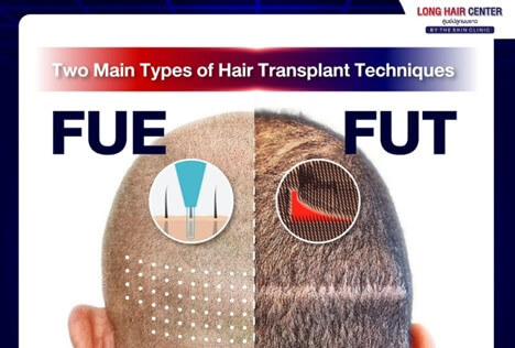 The difference between short hair vs. long hair transplantation.