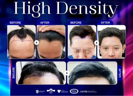 What types of hair loss and thinning can be treated with a hair transplant?