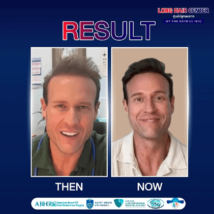 Real Case! Australian Doctor Flies to Thailand for Hair Restoration with Dr. Top, Long Hair x ALMI Nano Fat