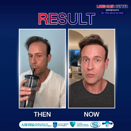 Real Case! Australian Doctor Flies to Thailand for Hair Restoration with Dr. Top, Long Hair x ALMI Nano Fat