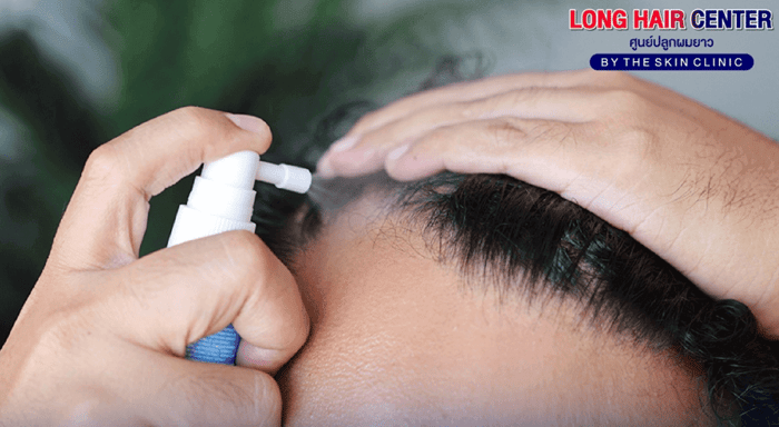 : A Survival Guide to Coping with the Side Effects of Finasteride