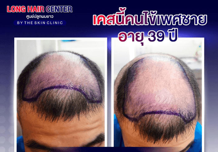 Hair Transplant for Men: Restoring Confidence with Short Hair & ALMI Nano Fat