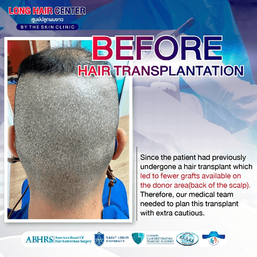 Hair Transplant for Men: Restoring Confidence with Short Hair & ALMI Nano Fat