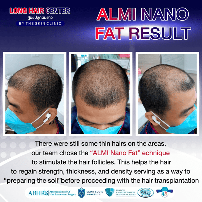 Hair Transplant for Men: Restoring Confidence with Short Hair & ALMI Nano Fat