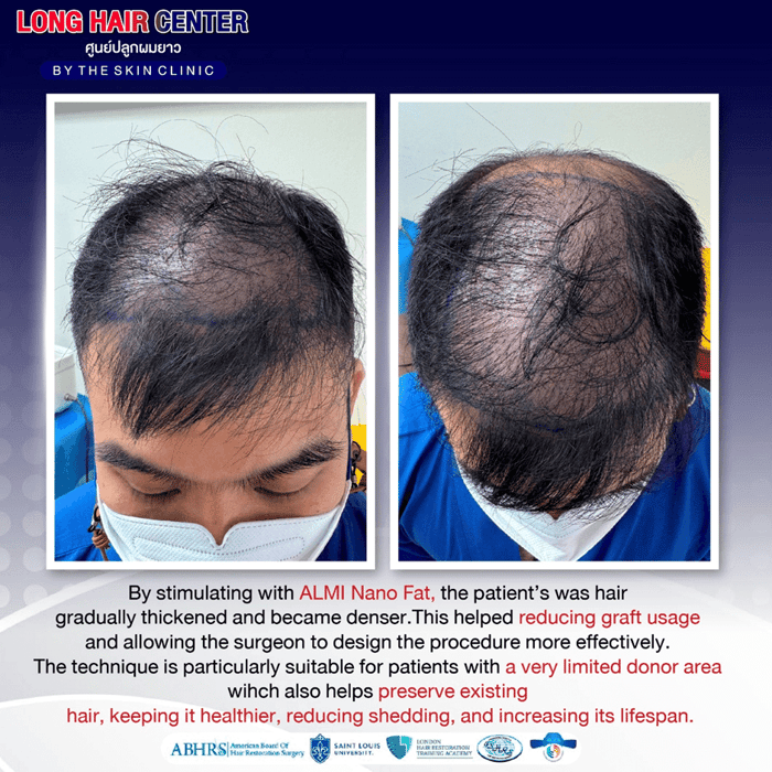 Hair Transplant for Men: Restoring Confidence with Short Hair & ALMI Nano Fat