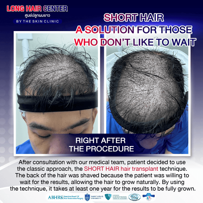 Hair Transplant for Men: Restoring Confidence with Short Hair & ALMI Nano Fat