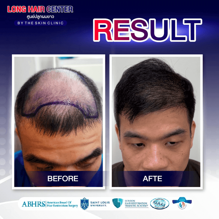 Hair Transplant for Men: Restoring Confidence with Short Hair & ALMI Nano Fat