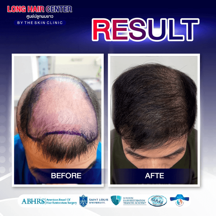 Hair Transplant for Men: Restoring Confidence with Short Hair & ALMI Nano Fat