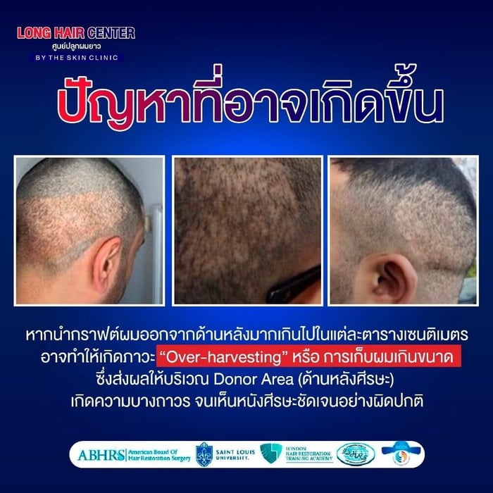 Size of the Donor Area