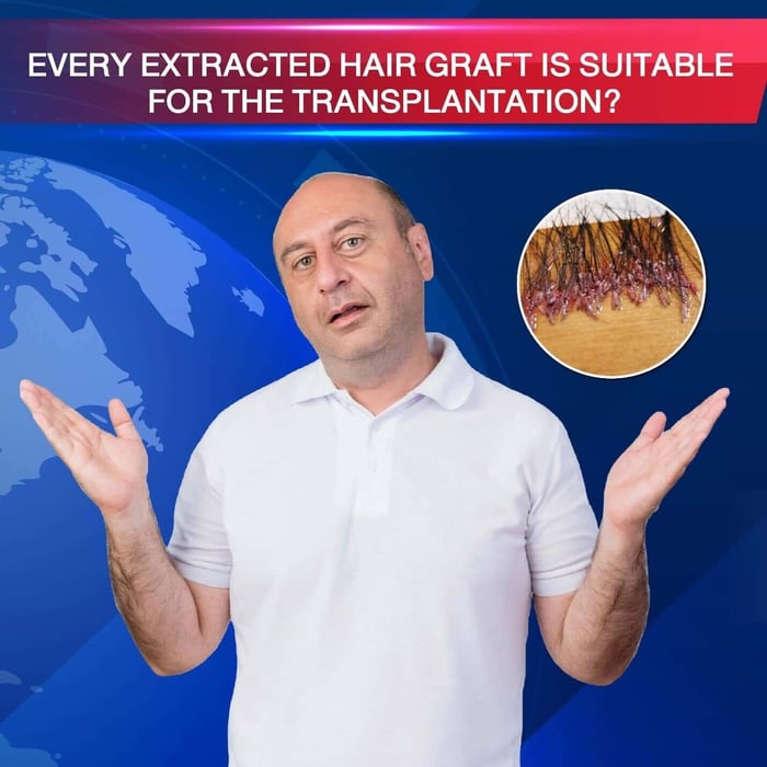 Are hair transplant results permanent?