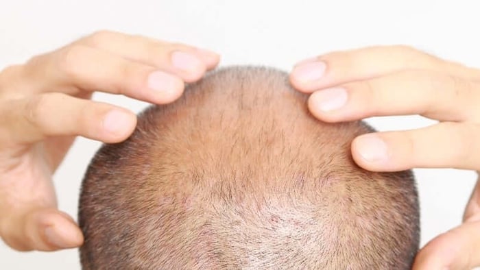 5-things-you-might-not-know-new-long-hair-transplants1.jpg