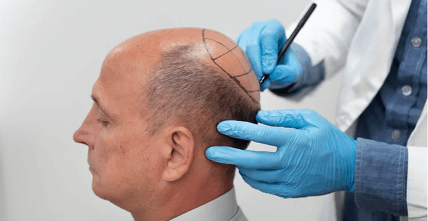 The Importance of Choosing an Experienced Hair Transplant Surgeon.