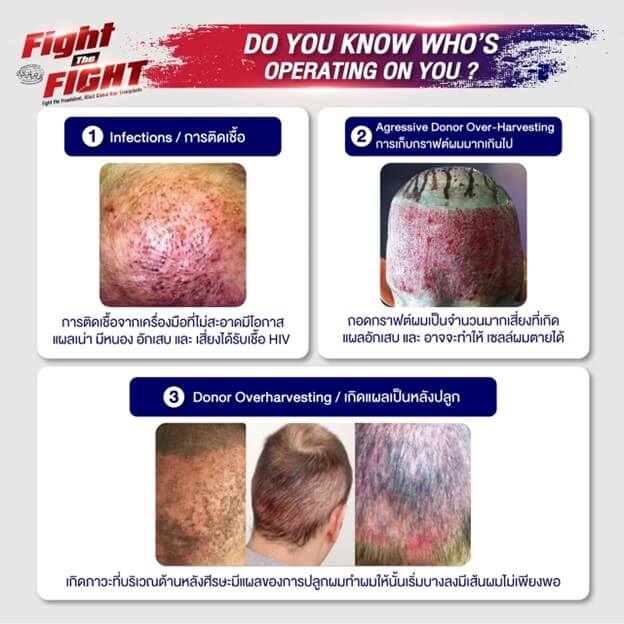 6 Risks of Unlicensed Hair Transplant Clinic