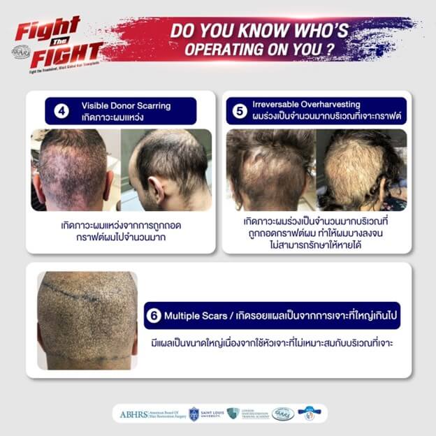 6 Risks of Unlicensed Hair Transplant Clinic