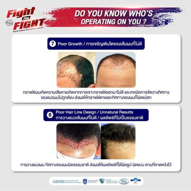 6 Risks of Unlicensed Hair Transplants Clinic