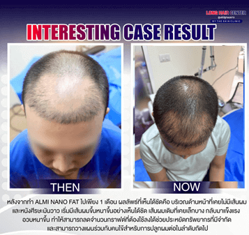 Hair loss, Hair Regrowth