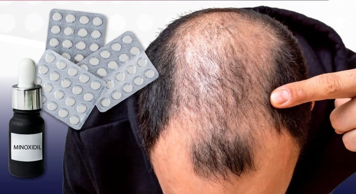 Does Minoxidil work for everyone?