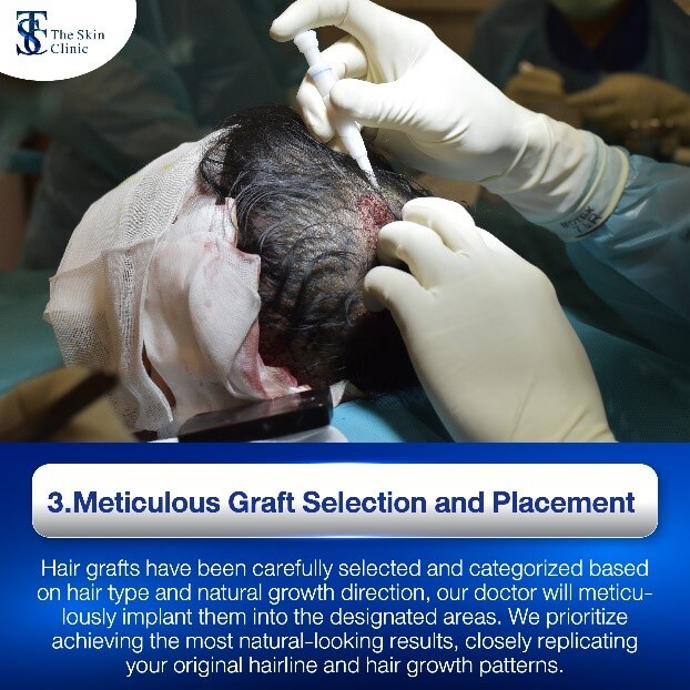 Selection of quality hair graft