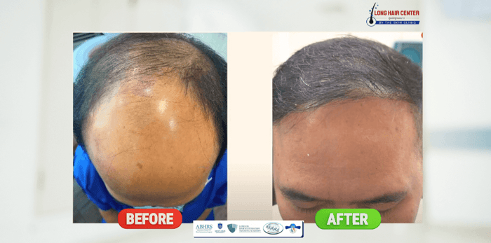 critical-hair-loss-don-lose-hope-hair-transplant-reviews-th-3.png
