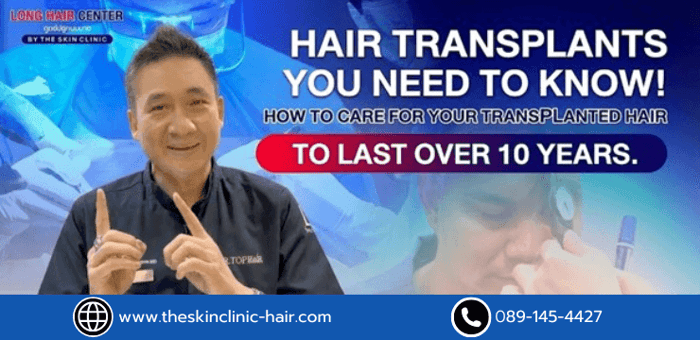 Hair Transplant Must-Know