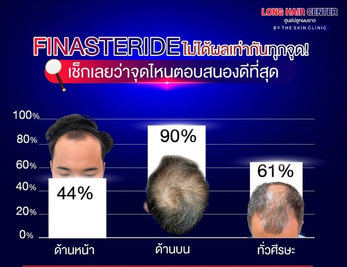 Finasteride does not work equally well on all areas. Different parts of the scalp may respond differently to the treatment