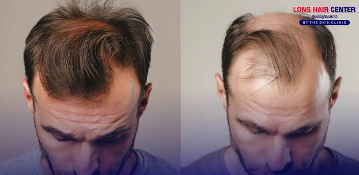 Hair loss treatment “Don’t wait until it’s too late. You should start taking care from the early stage.” If you decide to use Finasteride