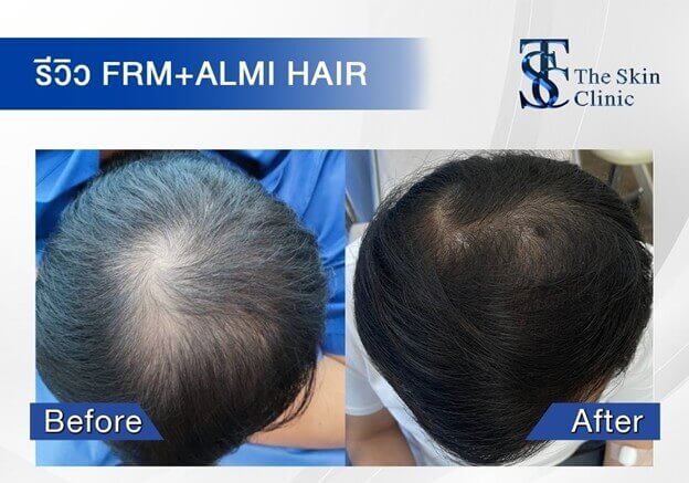 For individuals experiencing hair loss due to vitamin deficiencies, Polycystic Ovary Syndrome (PCOS), scalp inflammation, or infections, FRM Anti-Hair Loss is not recommended until the underlying cause of hair loss has been properly treated. Additionally, this technique is not suitable for cases of complete baldness where no hair follicles remain, as the treatment would not yield any results.