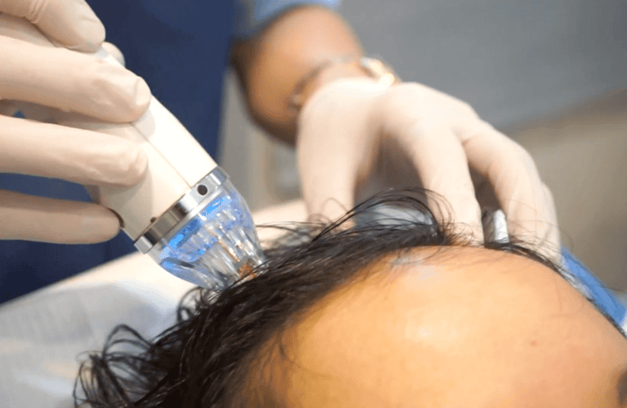 FRM Anti-Hair Loss is an advanced technology for treating hair loss and stimulating new thicker hair growth. It combines microneedling with radio frequency (RF) to deliver thermal energy directly to the Bulge area, an essential region for follicle regeneration and hair regrowth