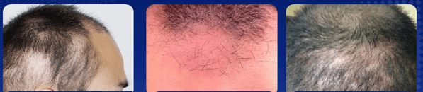 What Is Shock Loss After Hair Transplant?
