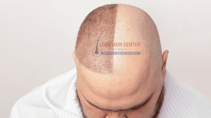 Hair transplantation is a procedure to restore hair in areas affected by thinning or baldness, such as the hairline or the crown of the head. It involves transferring hair follicle cells guide to hair transplants