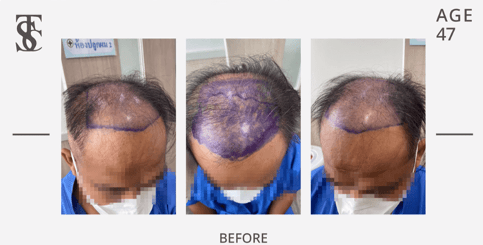 What Kind of Case is not Recommended Immediately for Hair Transplant?