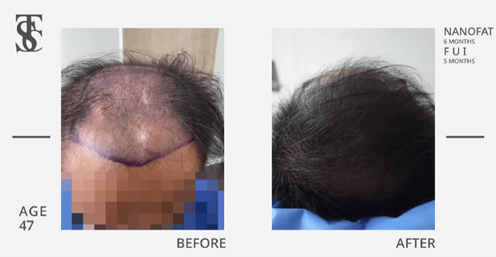 What Is ALMI Nano Fat, and How Does It Treat Hair Loss and Thinning?