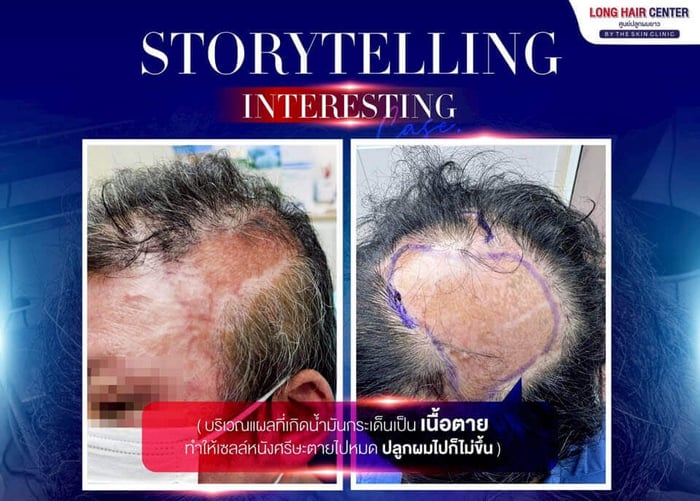 Hair Transplant on Scar. A Life-Changing: Baldness from a Severe Oil Burn