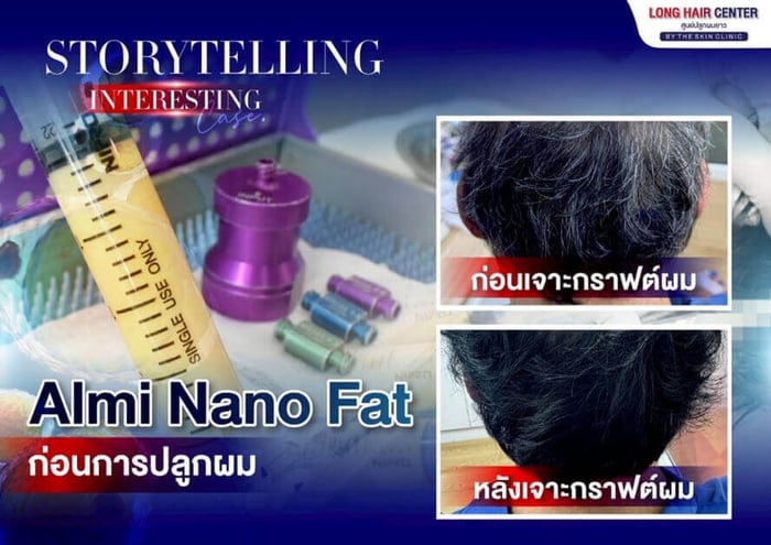 Hair Transplant on Scar. A Life-Changing: Baldness from a Severe Oil Burn