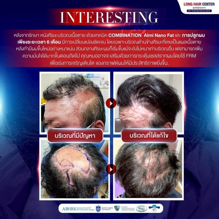 Hair Transplant on Scar. A Life-Changing: Baldness from a Severe Oil Burn